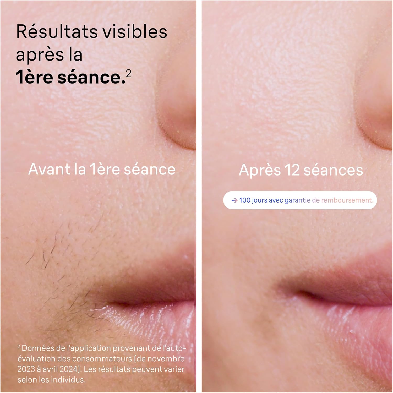 Épilation Domestique: Épilateur Intelligent À Lumière Pulsée – Image 4