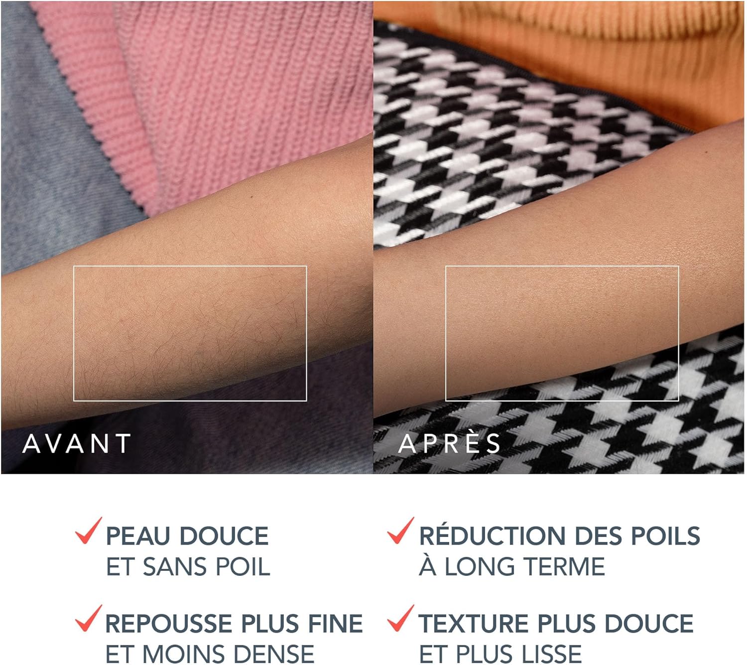 Épilation Permanente IPL : Peau Lisse à Domicile – Image 5